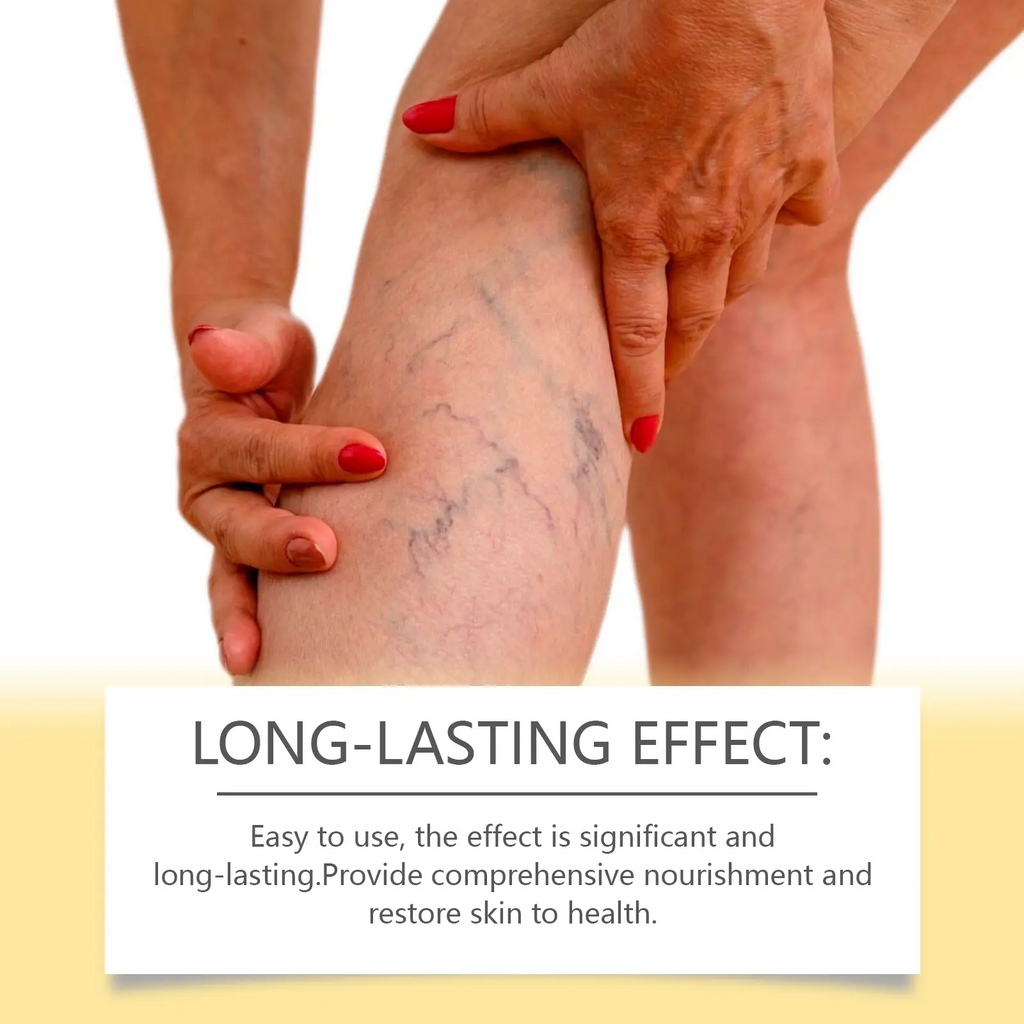 Pain & Swelling Relief Body Lotion, 100g Moisturizer  Bee Venom Extract Varicose Veins Cream,
