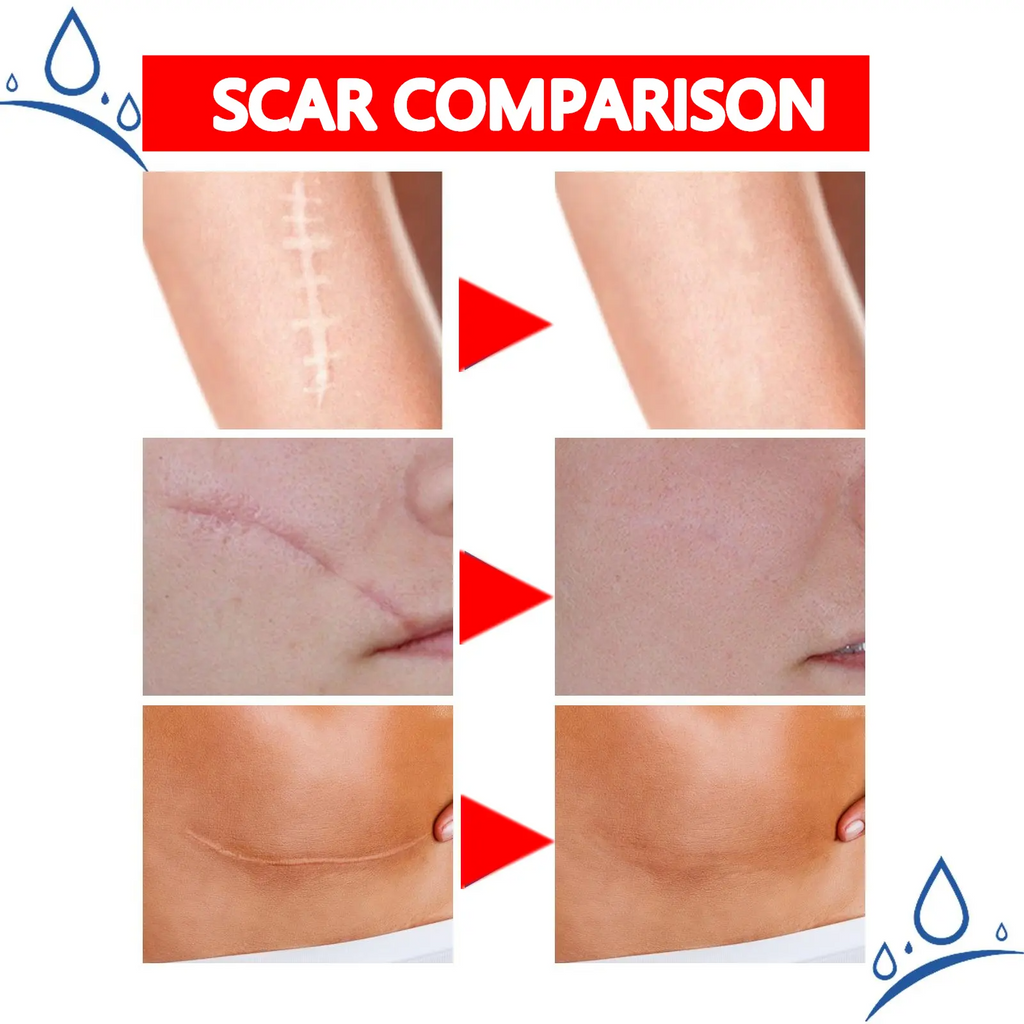 Professional Scar Removal Gel – Advanced Treatment for Keloids, C-Section, Surgery, Burn & Acne Scars